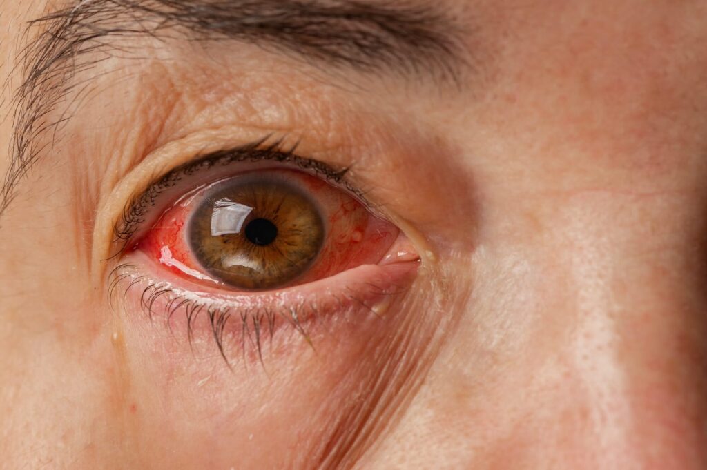 retinal diseases