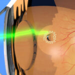 Retinal Treatments: Advanced Solutions for Eye Health