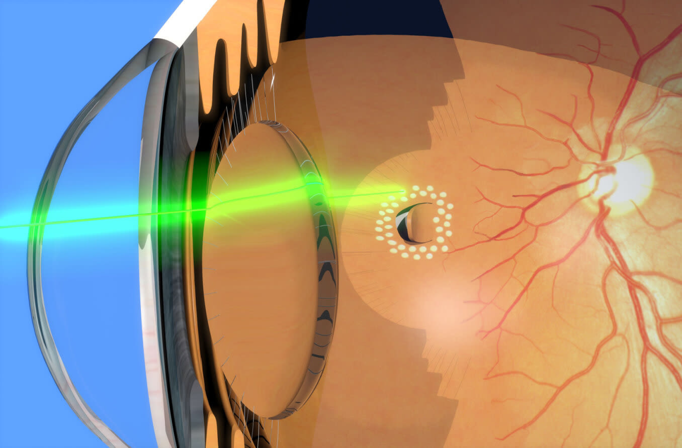 retinal treatments