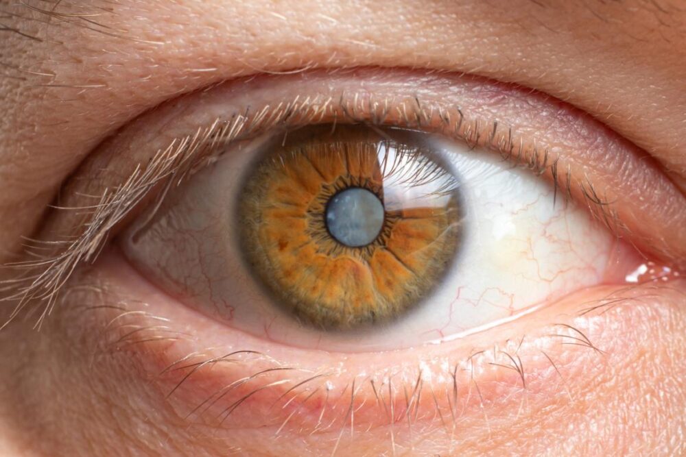 LASIK Surgery