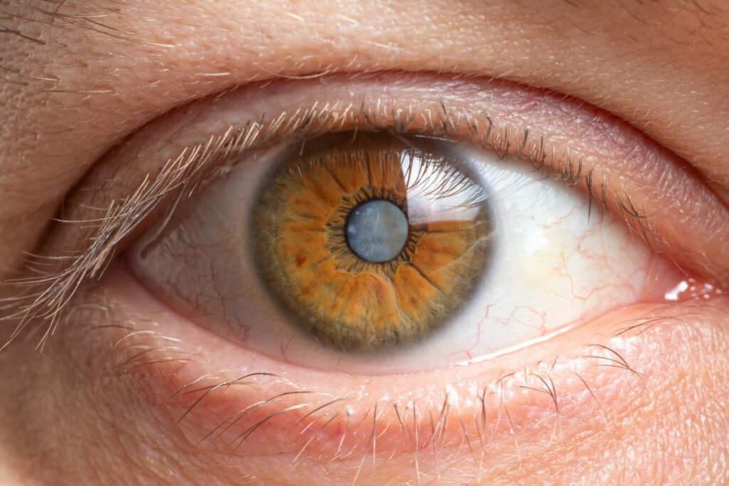LASIK Surgery