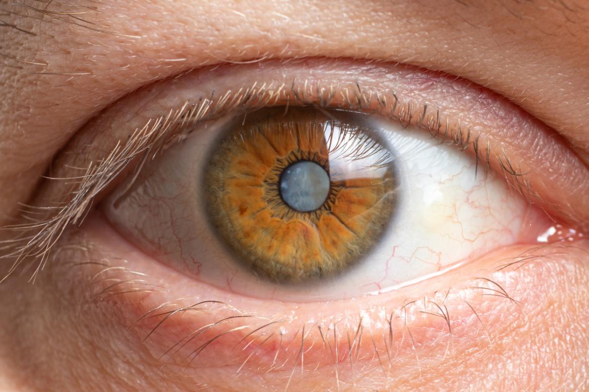 cataract eye surgery