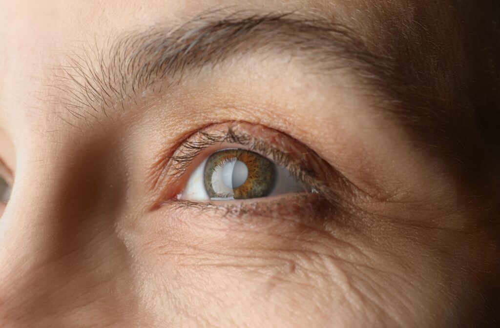 cataract eye surgery