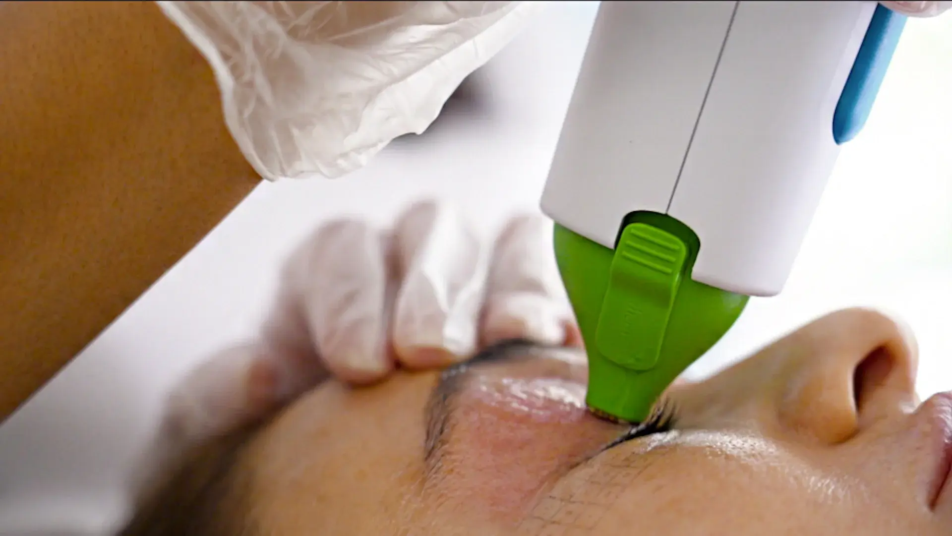 Why Private Cataract Surgery Cost Varies Between Surgeons